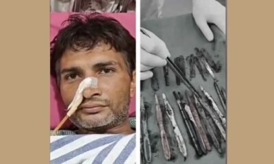 Ghaziabad man’s stomach filled with 29 spoons, 19 toothbrushes