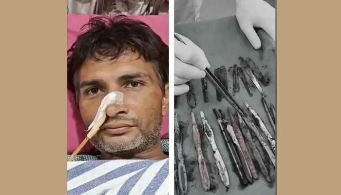 Ghaziabad man’s stomach filled with 29 spoons, 19 toothbrushes Ghaziabad man’s stomach filled with 29 spoons, 19 toothbrushes
